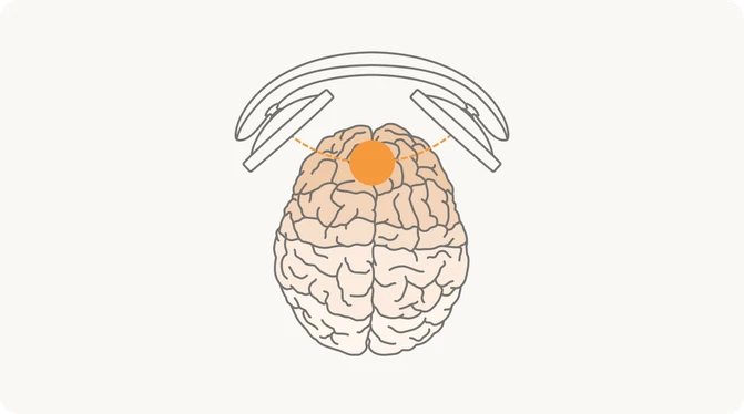 Brain illustration showing tDCS stimulation of the prefrontal cortex